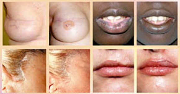 Dermaoz dermographie réparatrice par dermopigmentation